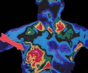 Breast thermography image